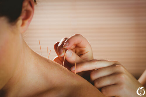 Young woman getting acupuncture treatment